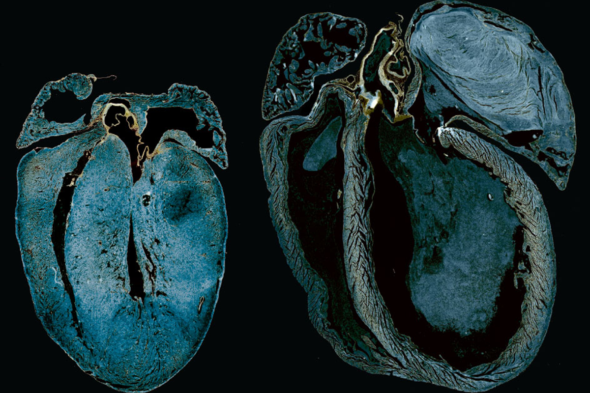 Two hearts, one with normal energy production and one, larger, showing an energy production deficiency.