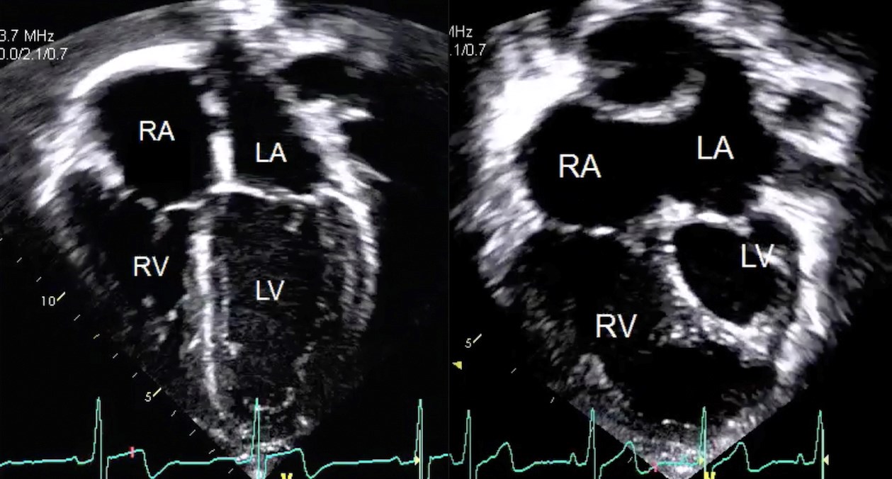The Echocardiography Laboratory provides diagnostic cardiac ultrasound for children with suspected or known heart disease. The left panel shows an echocardiographic four-chamber view of a normal heart demonstrating the right atrium (RA), the right ventricle (RV), the left atrium (LA), and the left ventricle (LV). The right panel shows a four-chamber view of a heart with hypoplastic left heart syndrome, note the small left ventricle and dilated right ventricle.